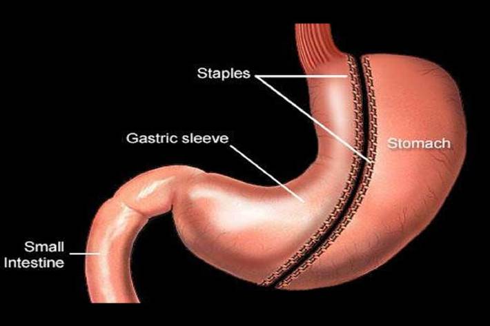 یکی از رایج‌ترین روش‌ها برای کاهش وزن جراحی چاقی است که در آن معده فرد کوچک می‌شود.