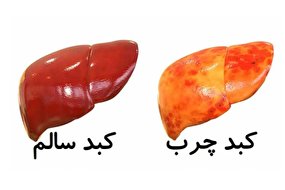 تاثیر کرونا بر تشدید بیماری کبد چرب