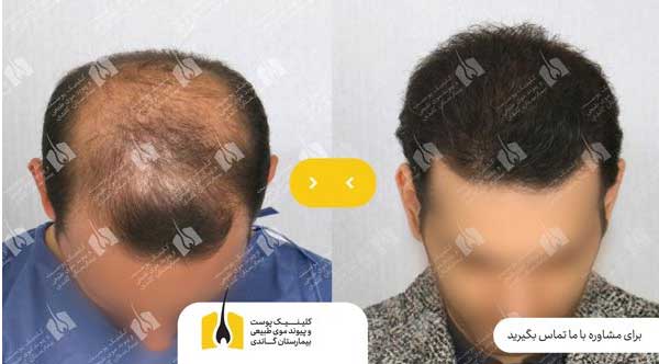 نکات ضروری که باید در مورد جراحی کاشت مو بدانید