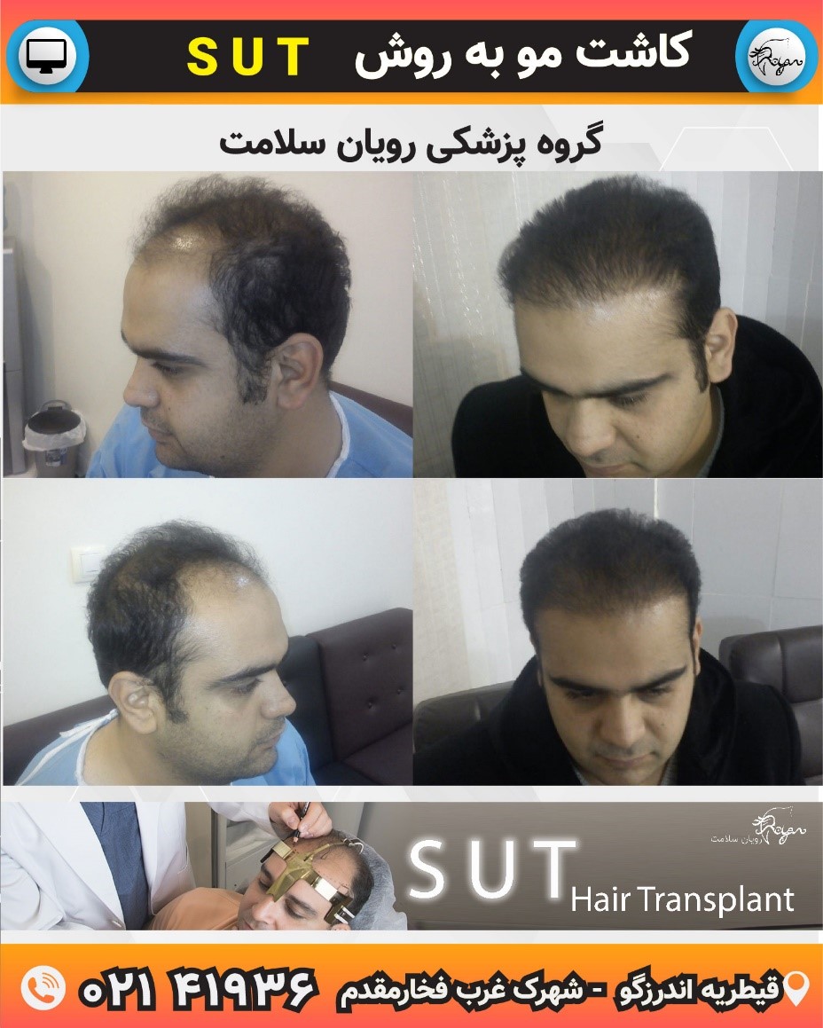 آیا نتایج کاشت مو دائمی است؟