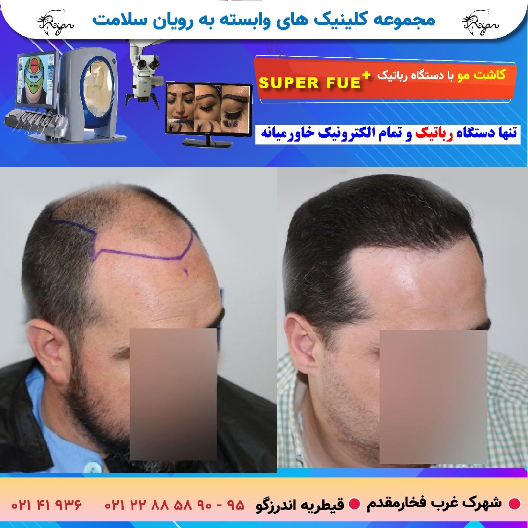 آیا نتایج کاشت مو دائمی است؟