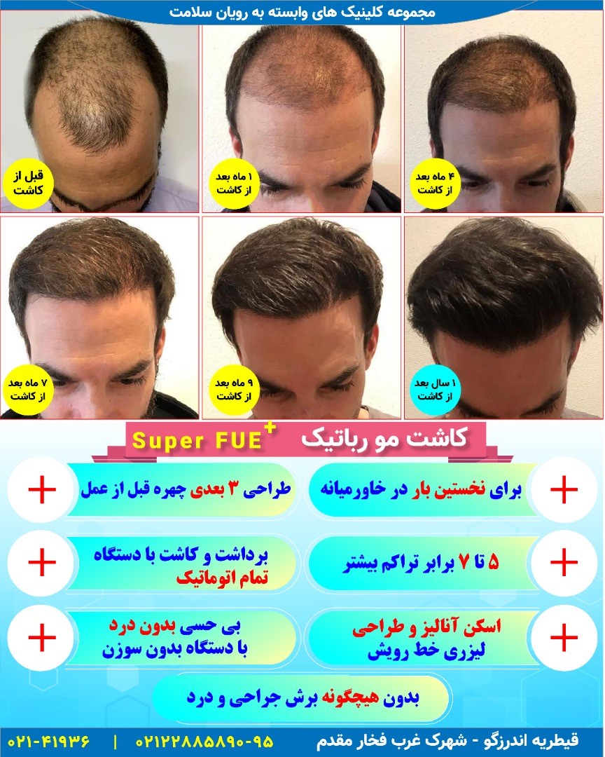 آیا نتایج کاشت مو دائمی است؟