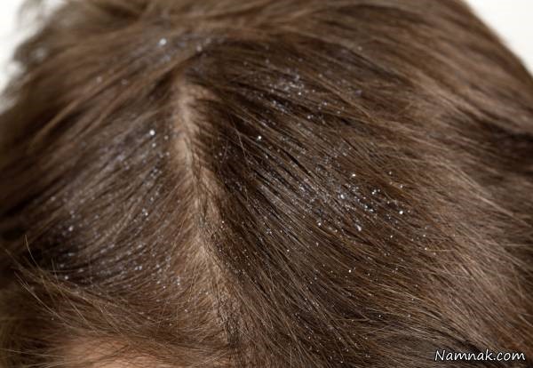 علت شوره سر و درمان آن به روش های کاملا طبیعی