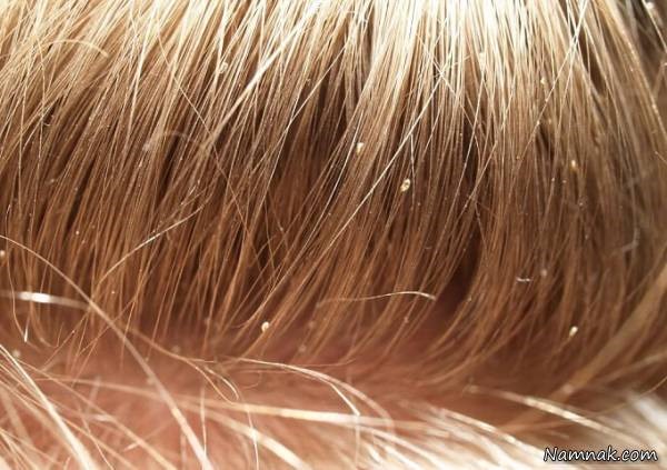 علت شوره سر و درمان آن به روش های کاملا طبیعی