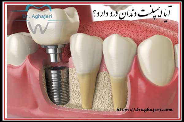 از سیر تا پیاز ایمپلنت دندان !! از سیر تا پیاز ایمپلنت دندان !!