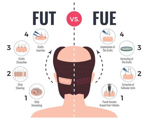 11 سوال متداول کاشت مو که برای همه پیش می آید 11 سوال متداول کاشت مو که برای همه پیش می آید