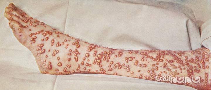 چگونه آبله در فتح امپراتوری آزتک به اسپانیایی&zwnj;ها کمک کرد؟