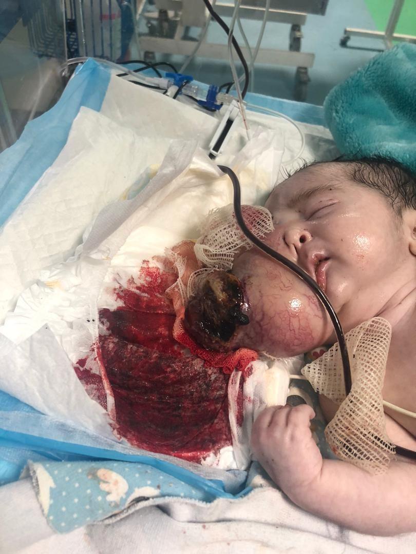 عمل جراحی نادر و موفقیت آمیز تخلیه تومور بزرگ از صورت نوزاد (+عکس) عمل جراحی نادر و موفقیت آمیز تخلیه تومور بزرگ از صورت نوزاد (+عکس)