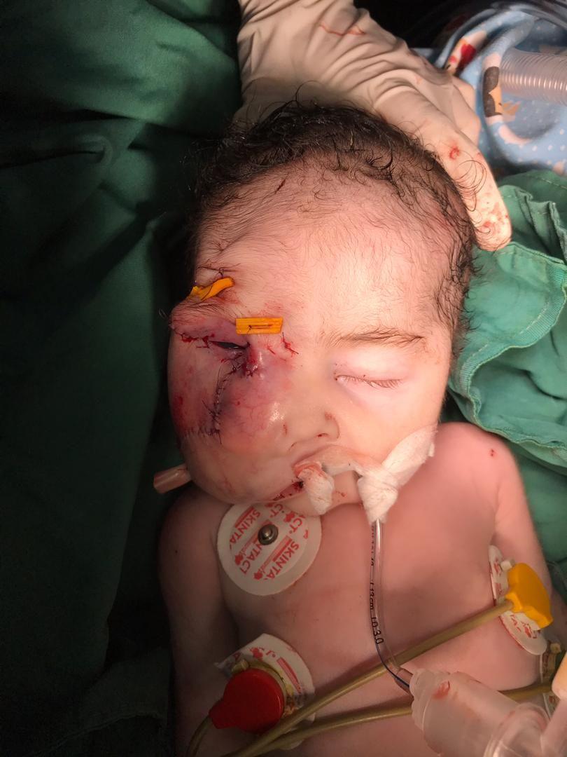 عمل جراحی نادر و موفقیت آمیز تخلیه تومور بزرگ از صورت نوزاد (+عکس) عمل جراحی نادر و موفقیت آمیز تخلیه تومور بزرگ از صورت نوزاد (+عکس)