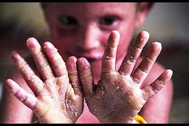 جراحی پلاستیک ۲۲۰ بیمار پروانه ای در شیراز