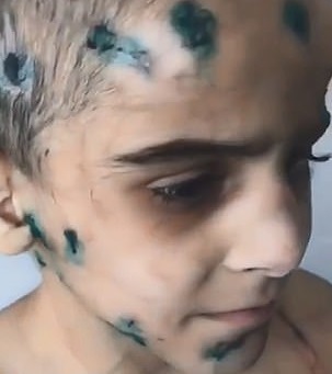 شکنجه های بی رحمانه عمه باعث قطع دست برادرزاده اش، «عایشه» شد