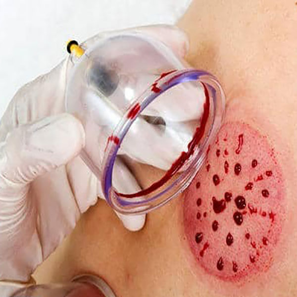 علائم نیاز بدن به حجامت در پاییز علائم نیاز بدن به حجامت در پاییز