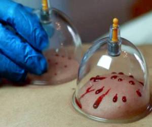 علائم نیاز بدن به حجامت در پاییز علائم نیاز بدن به حجامت در پاییز