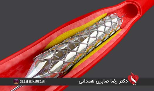 عوارض بعد از بالن زدن قلب عوارض بعد از بالن زدن قلب