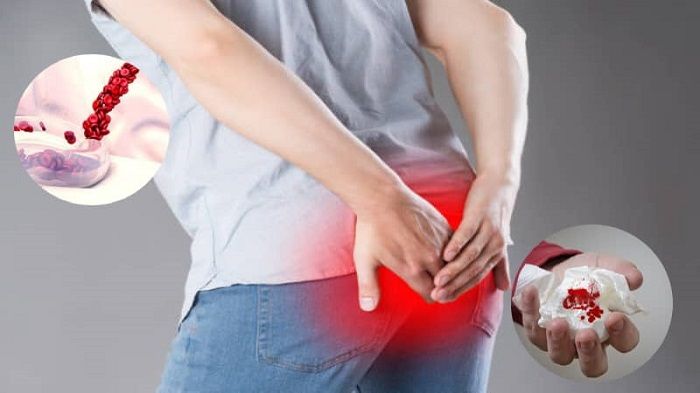 یبوست چیست و چه ارتباطی با خونریزی مقعدی دارد؟ + علائم و علت