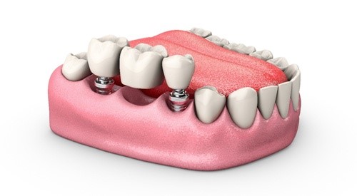 انواع سیستمهای ایمپلنت