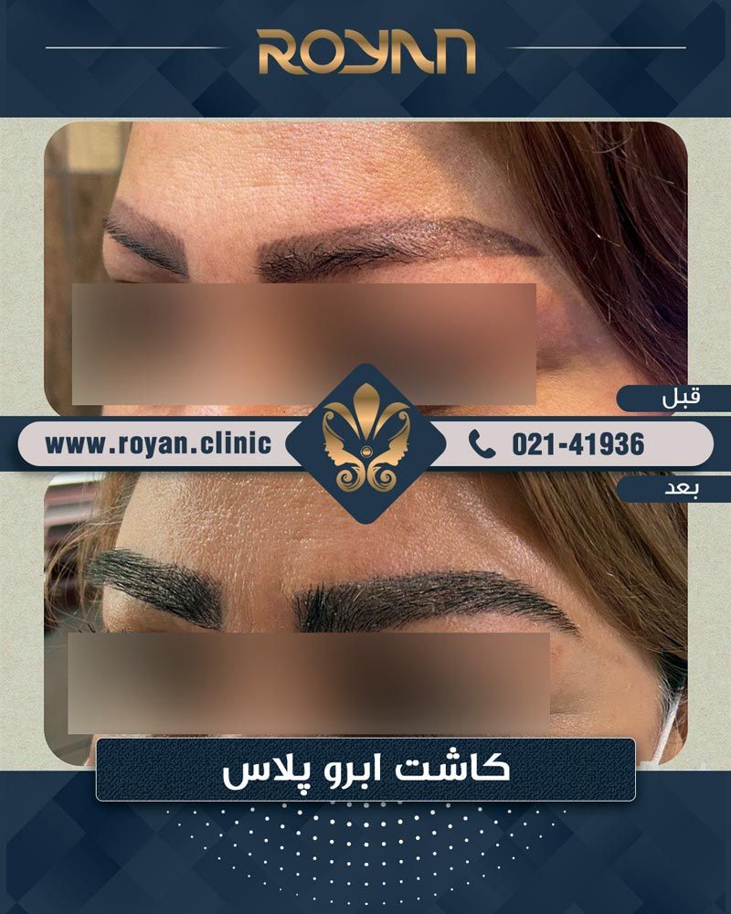 کاشت ابرو چیست و عوامل موثر بر هزینه کاشت ابرو