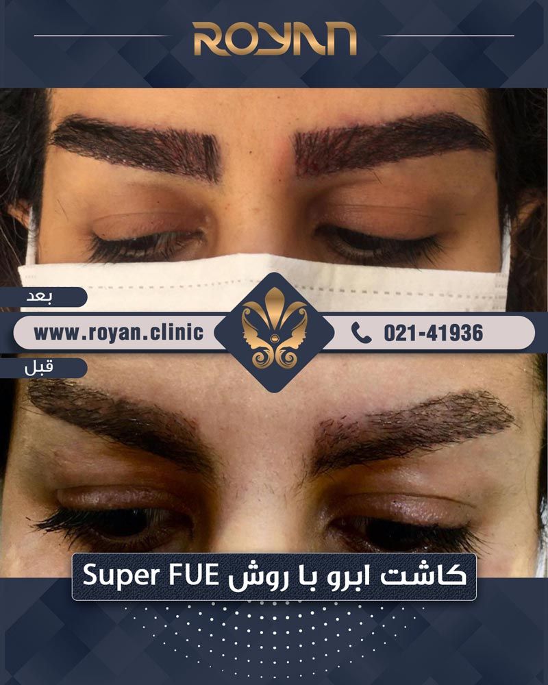 کاشت ابرو چیست و عوامل موثر بر هزینه کاشت ابرو