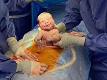 کاهش ۷ درصدی آمار سزارین در کرمانشاه