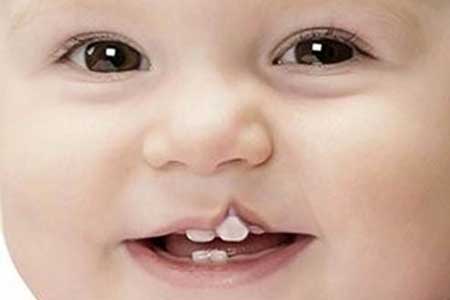 شکاف لب و کام درمانشدنی است شکاف لب و کام درمانشدنی است