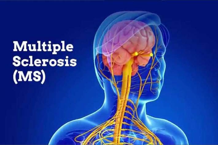 متخصص مغز و اعصاب گفت: کمبود ویتامین دی، عفونت‌ های ویروسی دوران کودکی یا نوجوانی، فاکتورهای نژادی و ارثی می‌توانند سبب بروز بیماری ام اس شوند.