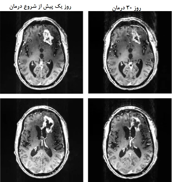 کلاه ایمنی مغناطیسی تومور مغزی کشنده را کوچک کرد