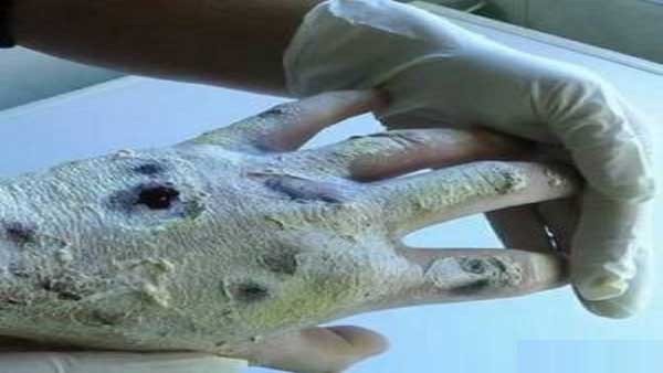 کروکودیل و تمساح مخدرهایی که بدن مصرف کننده را تکه تکه می کنند(+عکس) کروکودیل و تمساح مخدرهایی که بدن مصرف کننده را تکه تکه می کنند(+عکس)