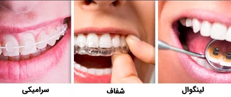 قیمت ارتودنسی نامرئی در سال 1400 چقدر است؟