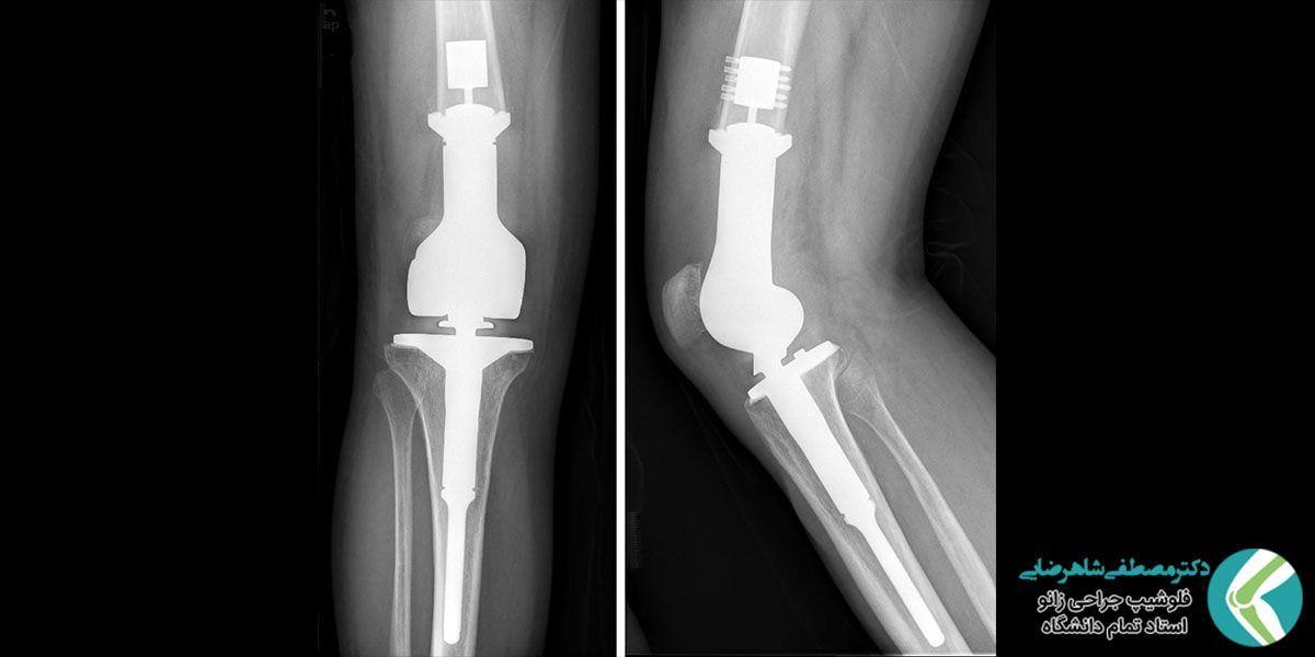 تعویض مفصل زانو در تهران