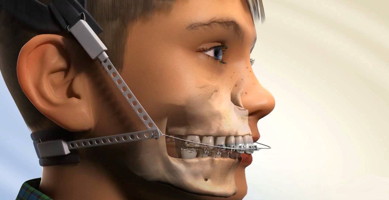 ارتودنسی پیشگیری چیست و هزینه آن چقدر است؟