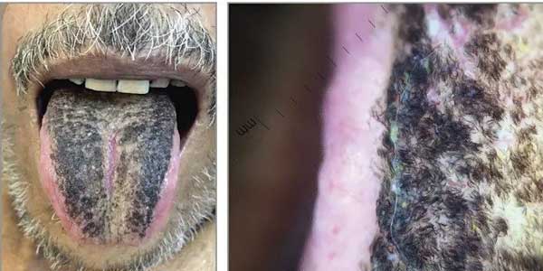 زبانم مو درآورد به معنای واقعی! (+عکس) زبانم مو درآورد به معنای واقعی! (+عکس)