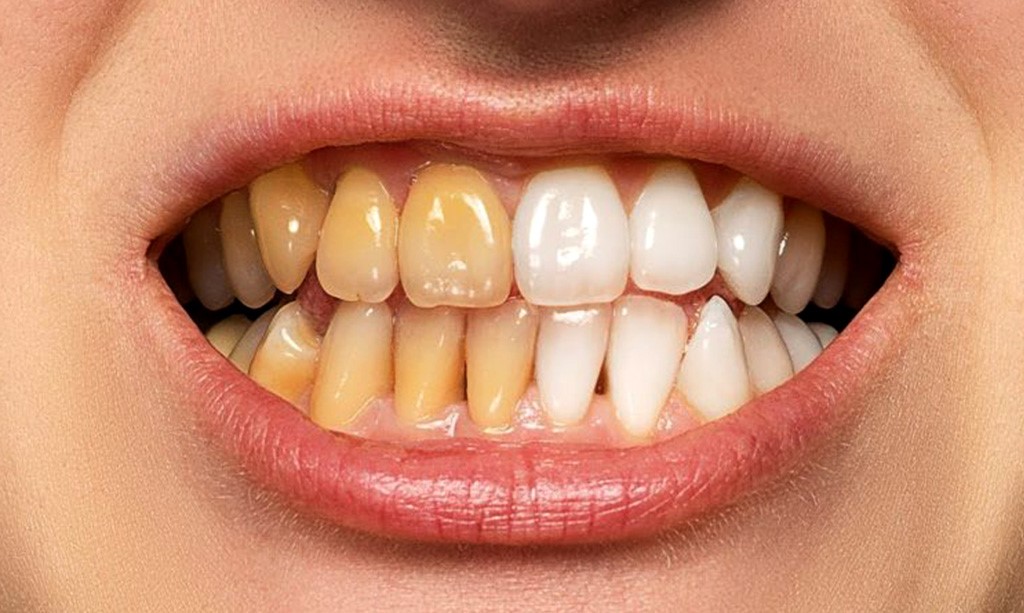 بلیچینگ دندان چیست و چه تفاوتی با جرمگیری دندان دارد؟