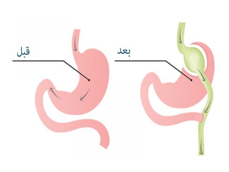 بهترین روش درمان چاقی مفرط چیست؟