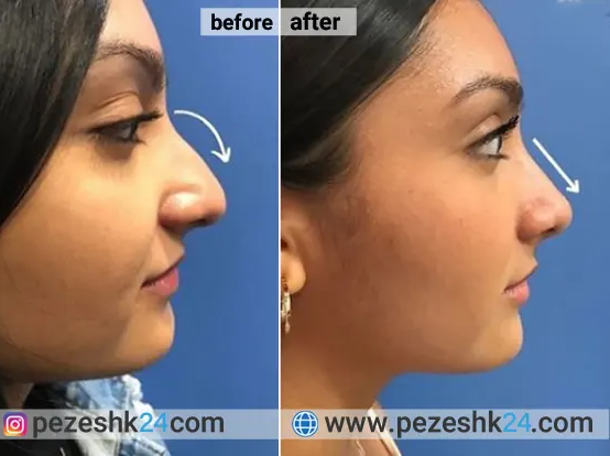 درد عمل بینی استخوانی بیشتره یا گوشتی