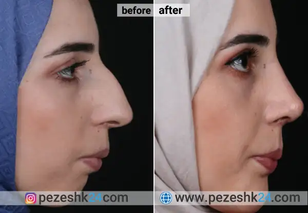 درد عمل بینی استخوانی بیشتره یا گوشتی