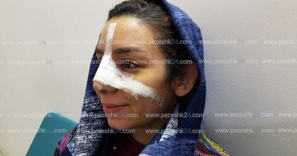 درد عمل بینی استخوانی بیشتره یا گوشتی