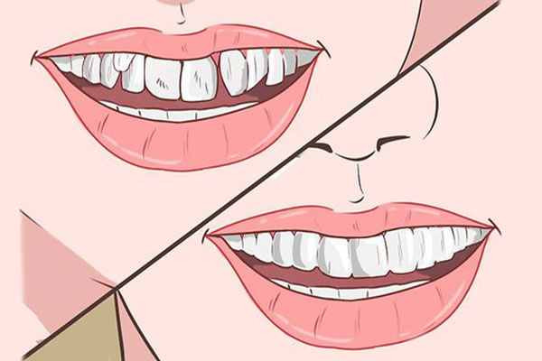 چند راهکار ساده برای داشتن دندان ردیف و منظم دندانهای بدشکل