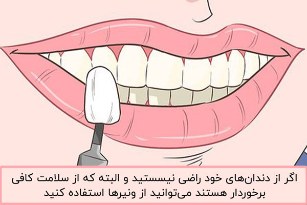 چند راهکار ساده برای داشتن دندان ردیف و منظم کامپوزیت ونیر دندان