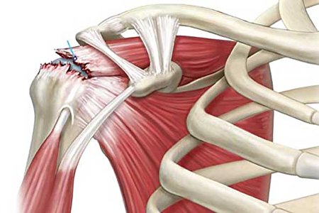ببینید | راههای تشخیص پارگی تاندون شانه
