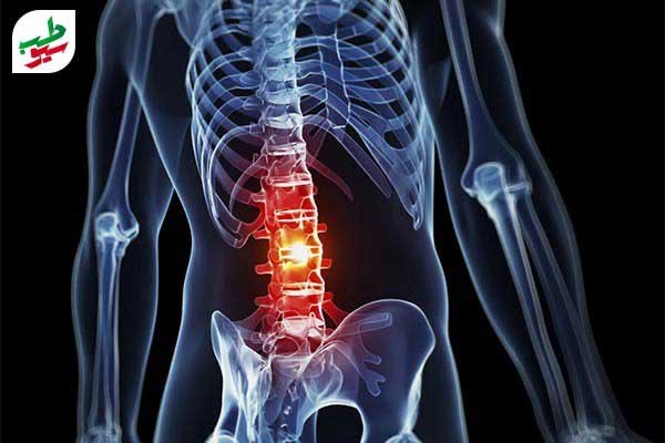کمر درد؛ درمان انواع دردهای کمر در پنج دقیقه کمر درد؛ درمان انواع دردهای کمر در پنج دقیقه