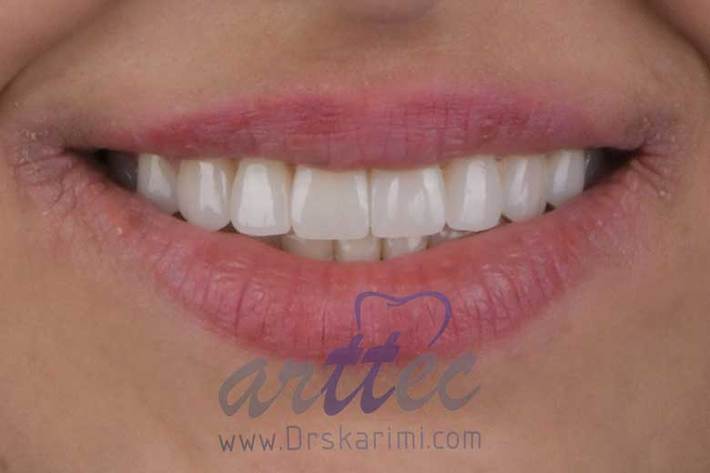 روکش دندان و لمینت های دندانی از ابزار مناسب برای درمان های دندانپزشکی به حساب می آیند، هر یک از این دو نوع ریستوریشن دندانی کاربرد خاص خود را دارد، مناسب بودن کدام یک از آن ها برای شما بستگی به نظر دندانپزشک دارد.