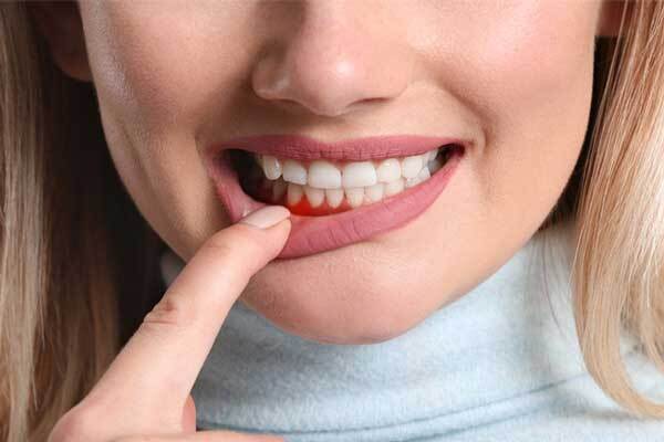 خونریزی لثه را جدی بگیرید و به فکر درمان آن باشید