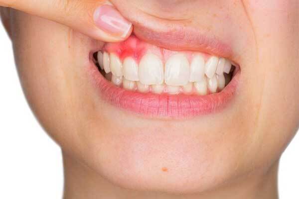 خونریزی لثه را جدی بگیرید و به فکر درمان آن باشید