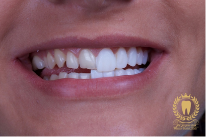 عصب کشی دندان در کلینیک دندانپزشکی تخصصی ماکان