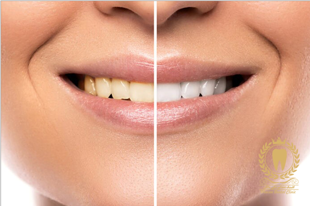 عصب کشی دندان در کلینیک دندانپزشکی تخصصی ماکان