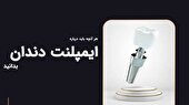 هر آنچه باید درباره ایمپلنت دندان بدانید: از ترس تا اعتماد
