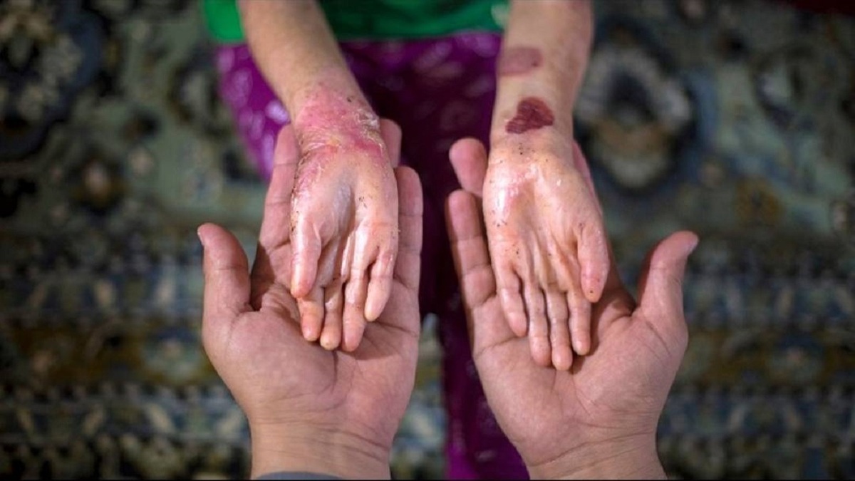 مدیر عامل بنیاد بیماری‌های نادر  گفت: 70 درصد از افراد مبتلا به بیماری‌های نادر به دلیل بی‌توجهی سازمان تامین اجتماعی تاکنون ‌نشان‌دار نشده و تحت پوشش بیمه تکمیلی قرار نگرفته‌اند.