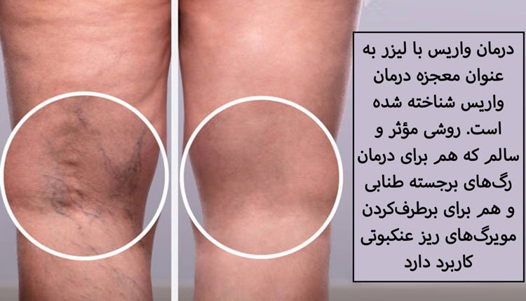 نکات کلیدی پس از عمل واریس پا با لیزر نکات کلیدی پس از عمل واریس پا با لیزر