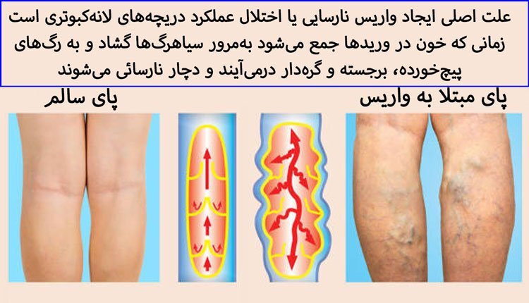 نکات کلیدی پس از عمل واریس پا با لیزر نکات کلیدی پس از عمل واریس پا با لیزر