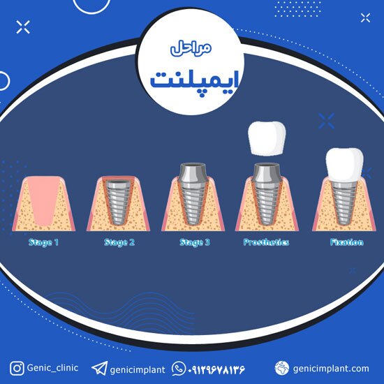 ایمپلنت دندان چیست و چقدر هزینه دارد؟ ایمپلنت دندان چیست و چقدر هزینه دارد؟